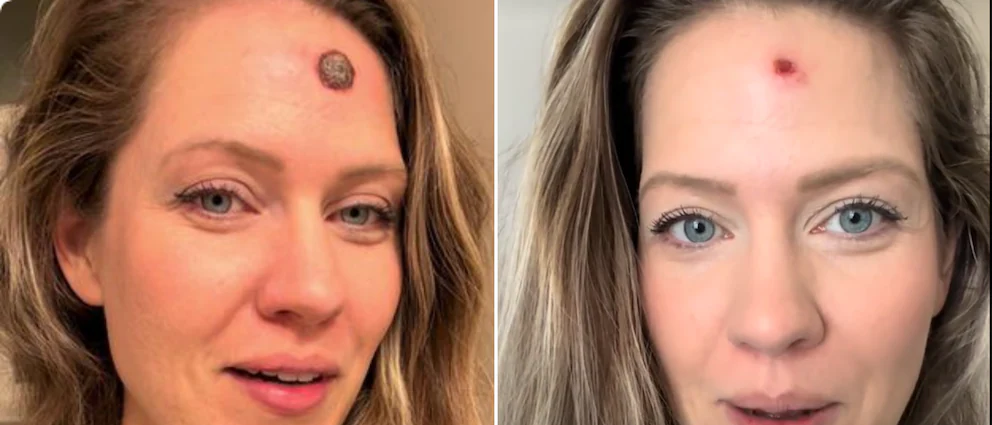 Rachel (33) hat seit zwei Jahren einen "Pickel" - doch dann folgt die Schockdiagnose